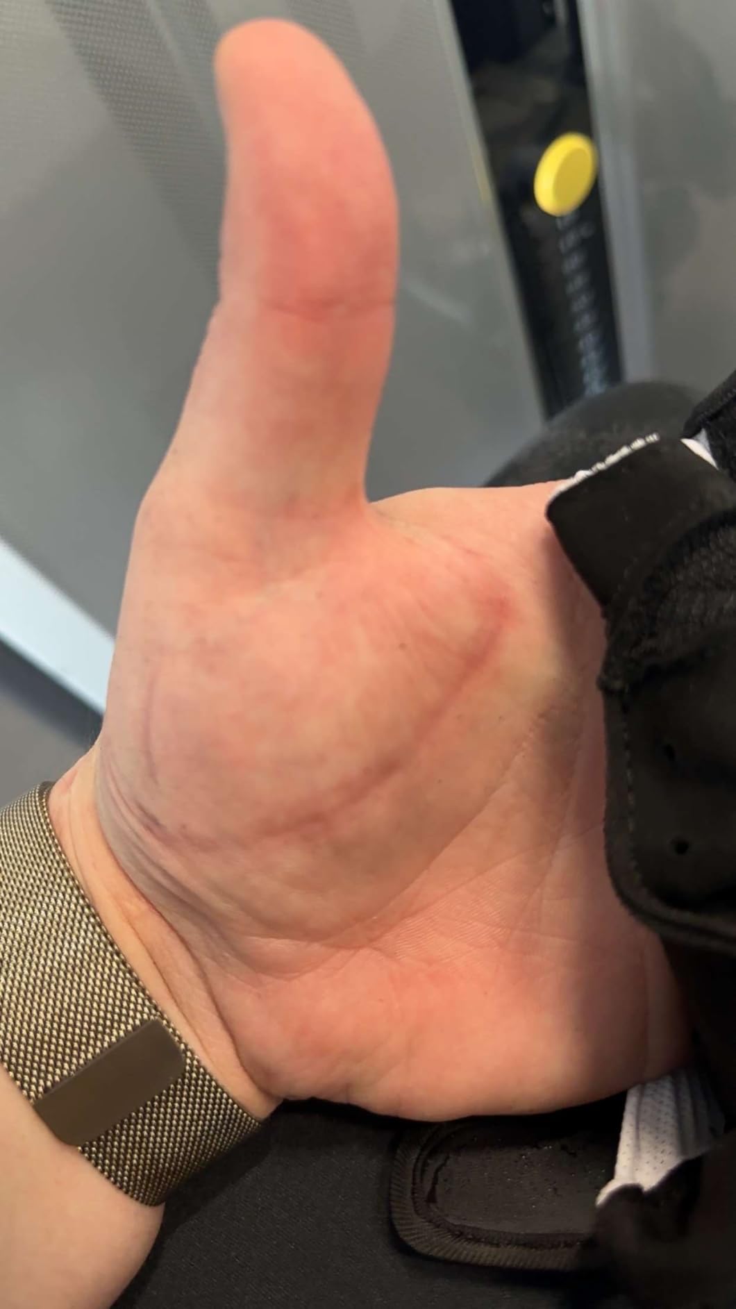 Endlich keine Hornhaut mehr